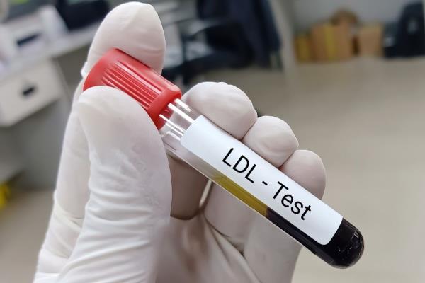 Cholesterol Test